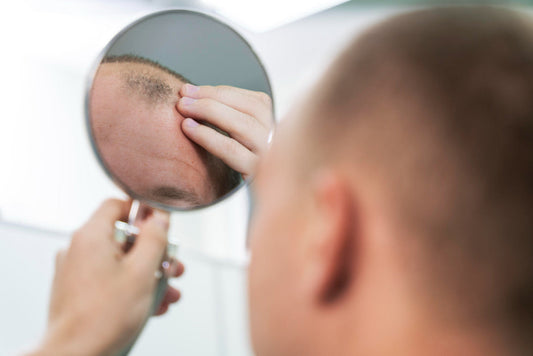 Tipos de alopecia: Cómo identificarlos, causas y tratamientos desde la farmacia