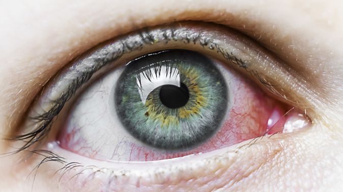 Toallitas Oculares Blefaritis Conjuntivitis